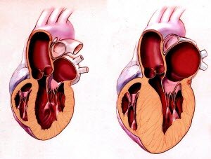 Увеличение левого желудочка сердца